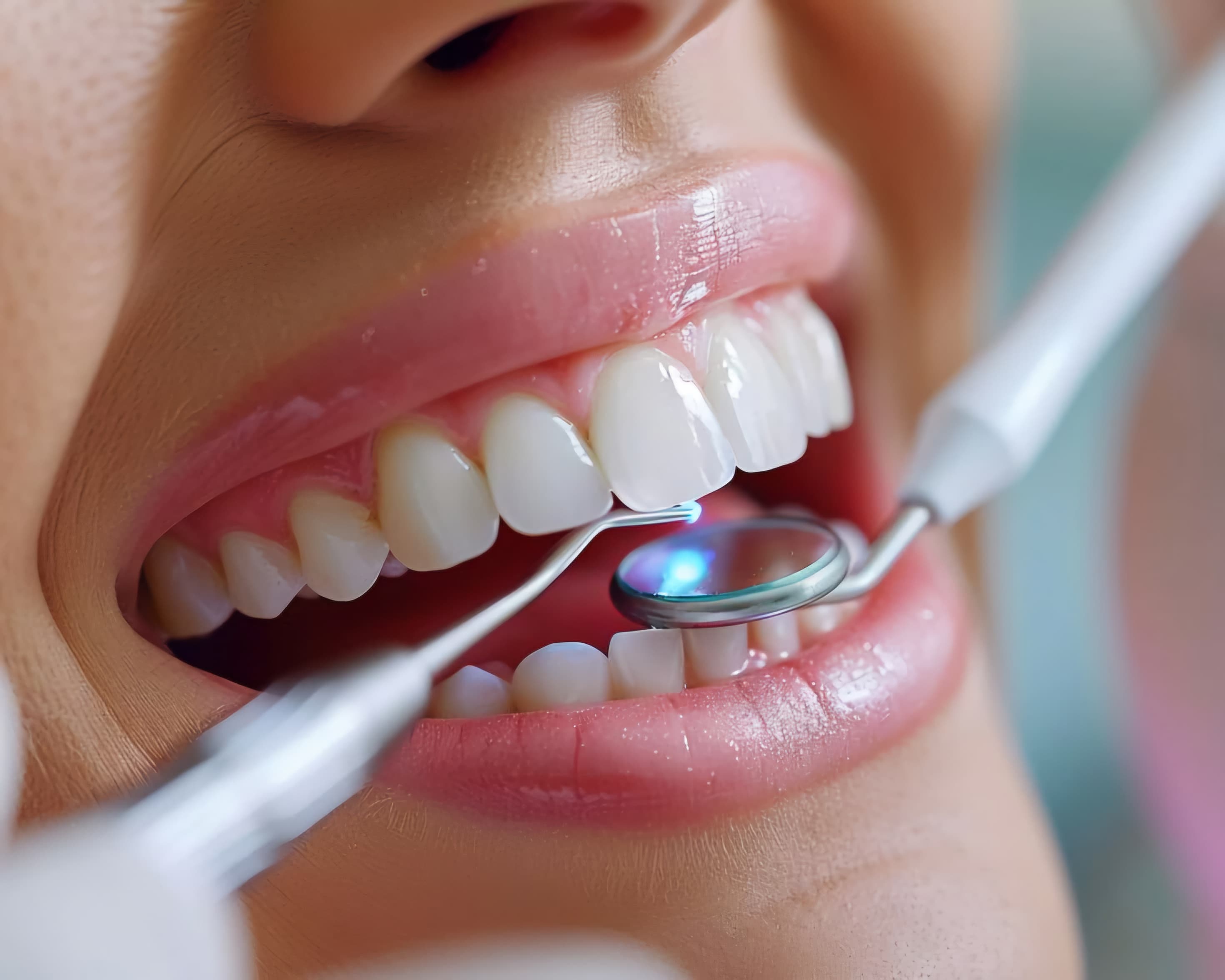 Close-up of natural-looking dental veneers on a teeth model