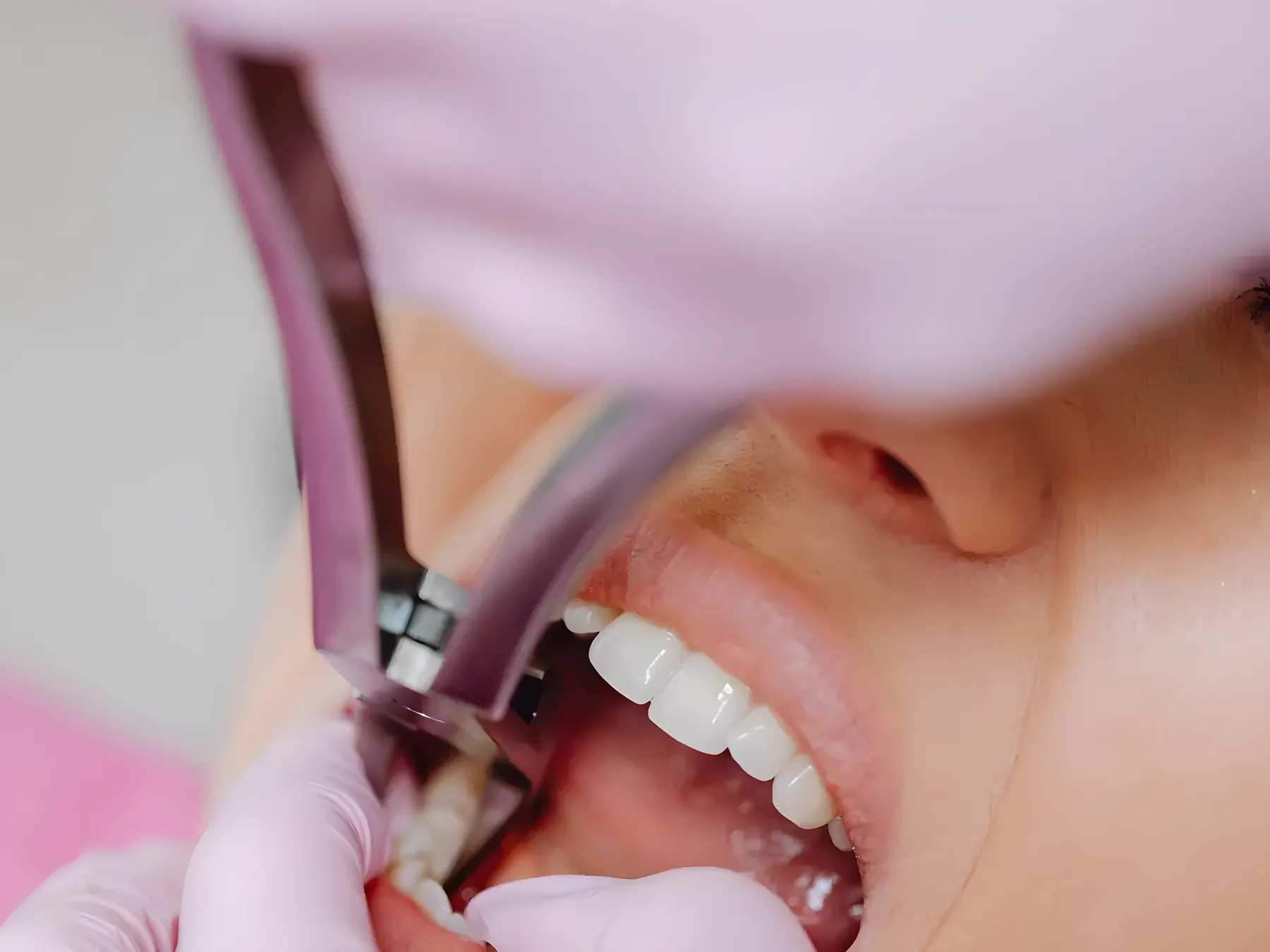 Patient undergoing a gentle tooth extraction procedure